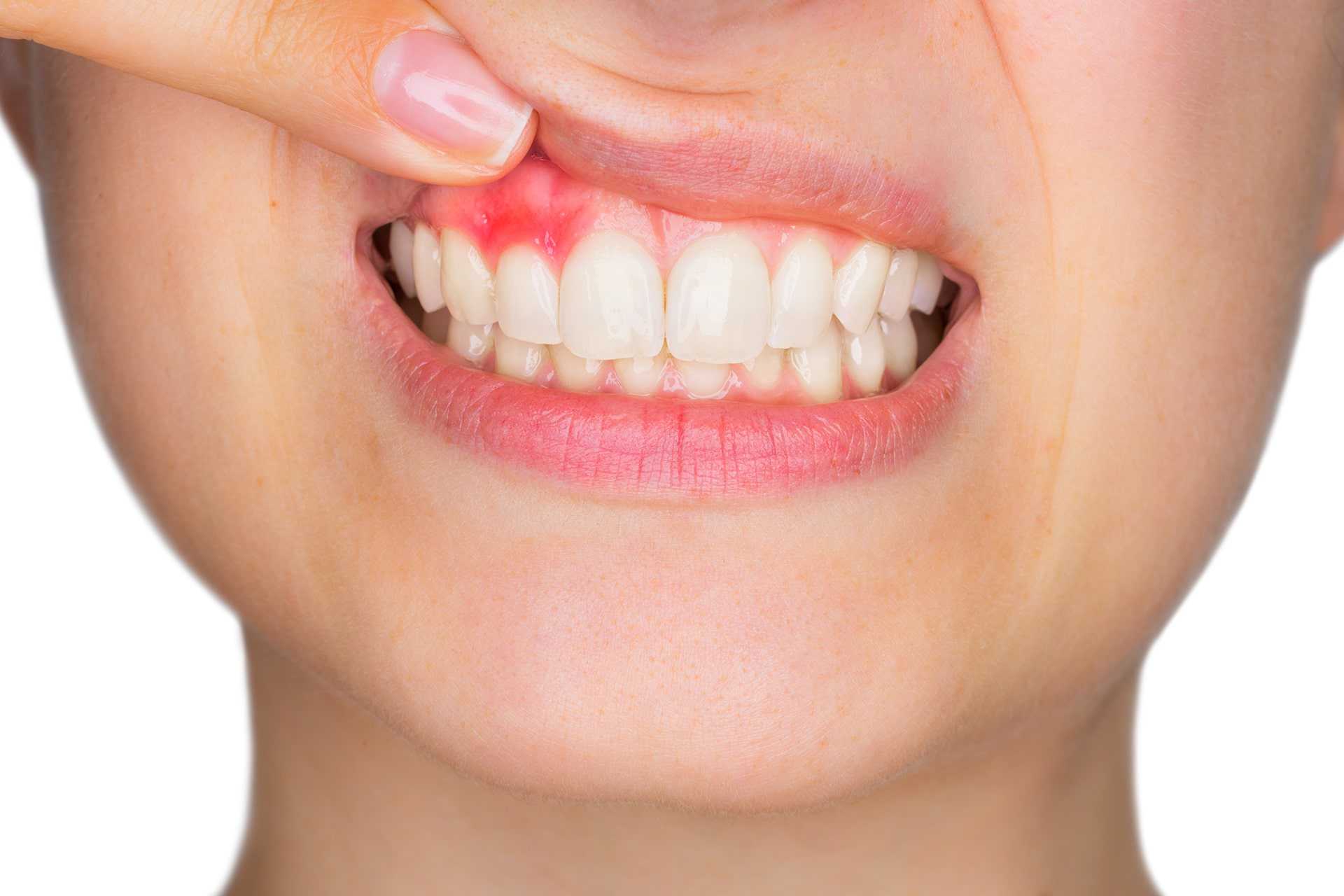 راه های درمان سریع آفت دهان و زبان