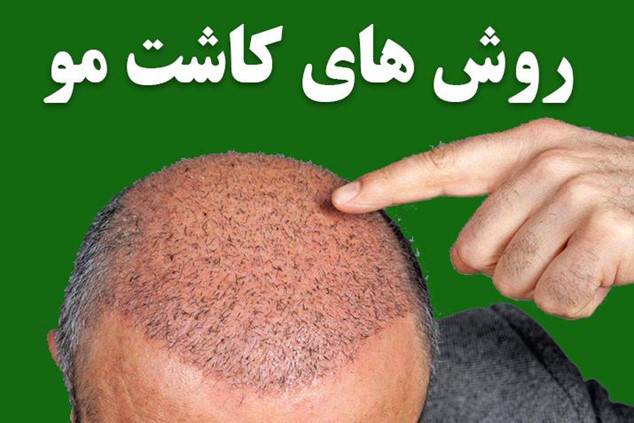 روش های کاشت مو در قزوین